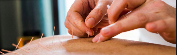 Acupuncture